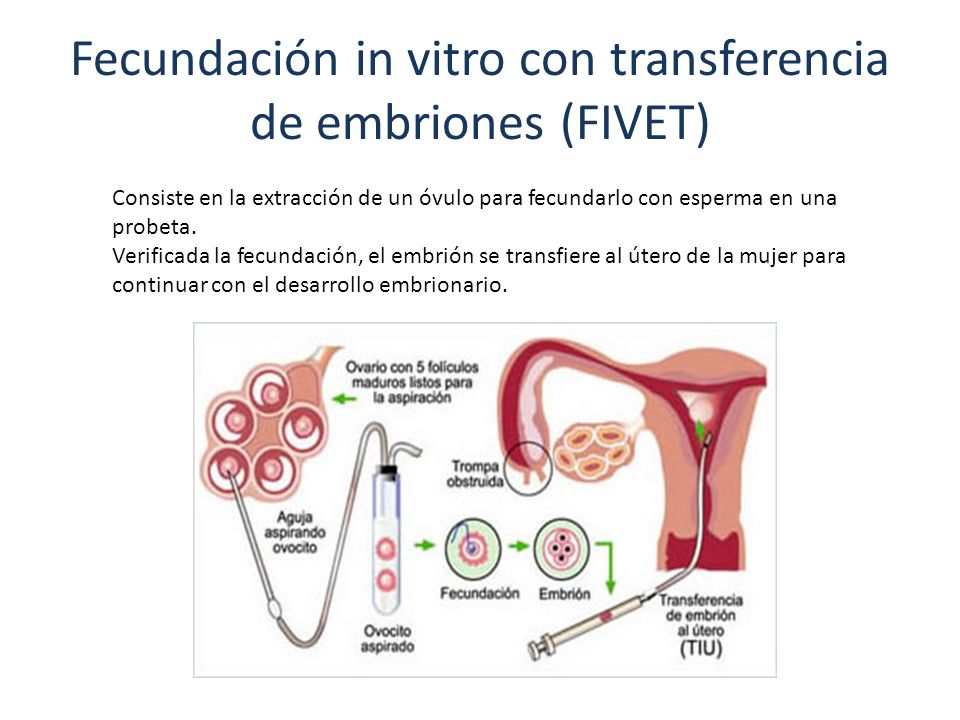 Fecundación in vitro con transferencia de embriones (FIVET)