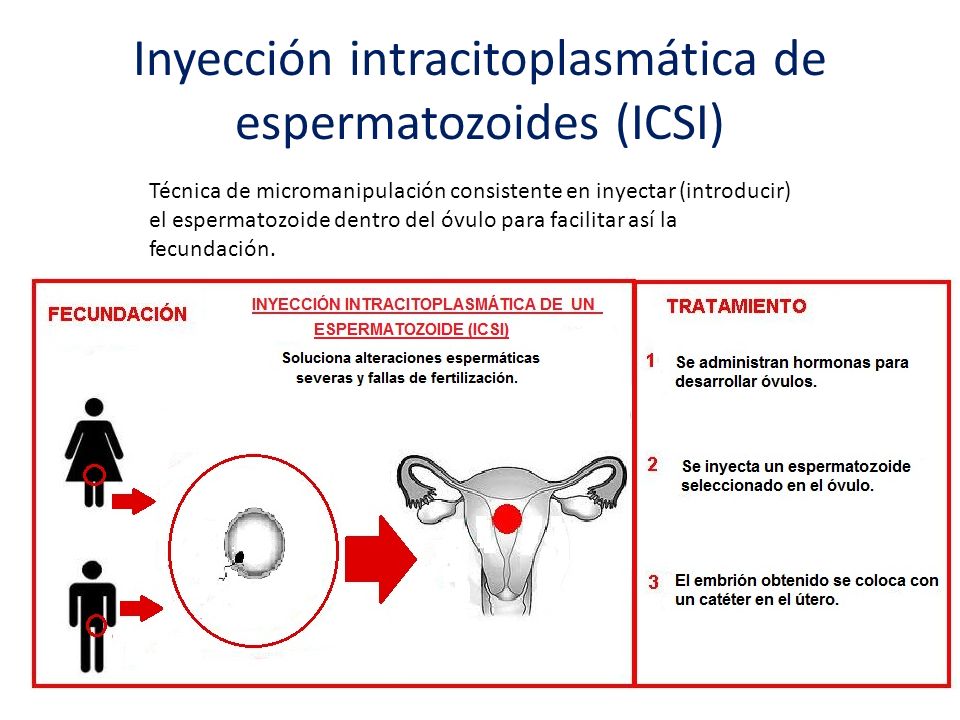 Inyección intracitoplasmática de espermatozoides (ICSI)