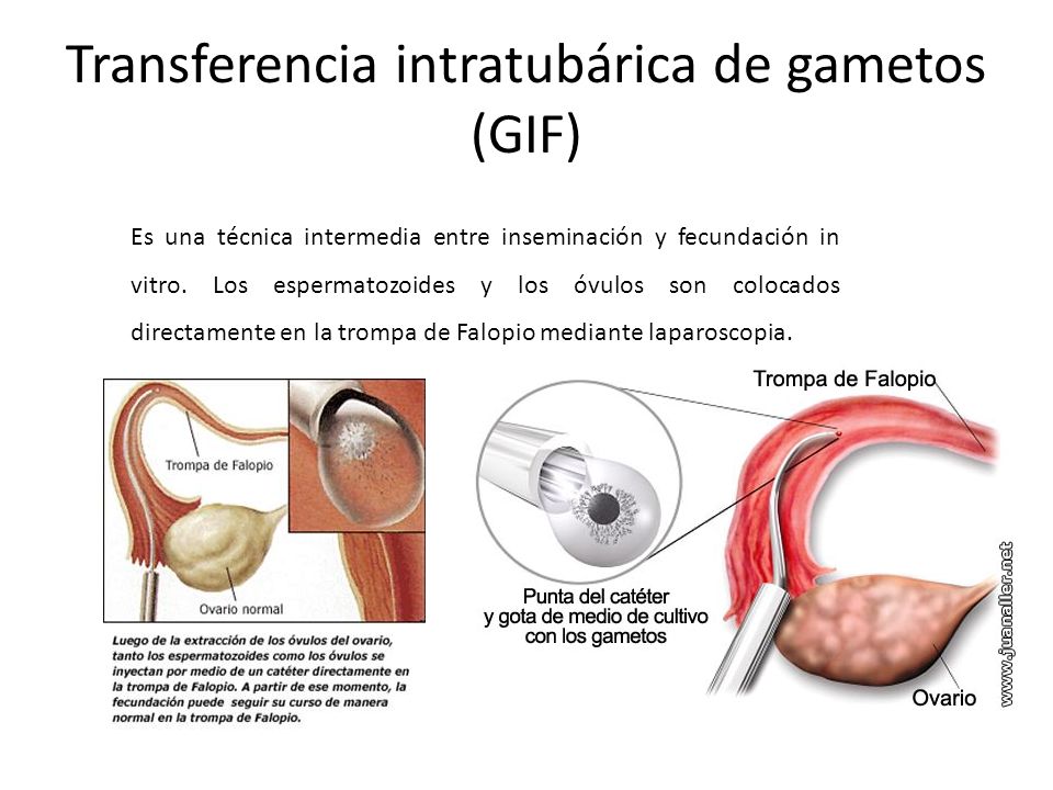 Transferencia intratubárica de gametos (GIF)