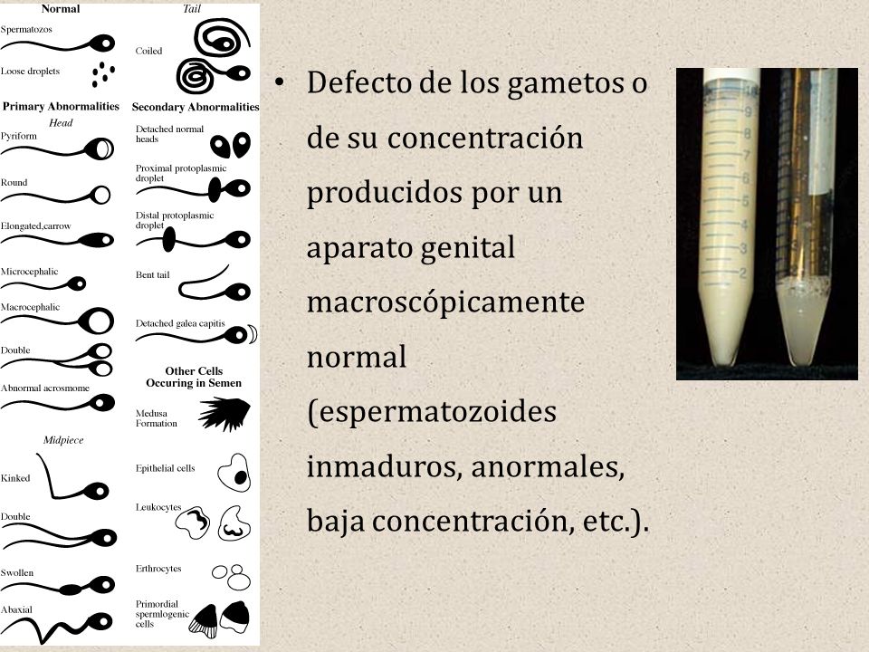 Defecto de los gametos o de su concentración producidos por un aparato genital macroscópicamente normal (espermatozoides inmaduros, anormales, baja concentración, etc.).