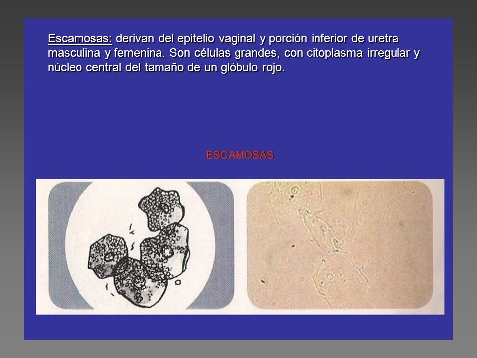 Escamosas: derivan del epitelio vaginal y porción inferior de uretra masculina y femenina.