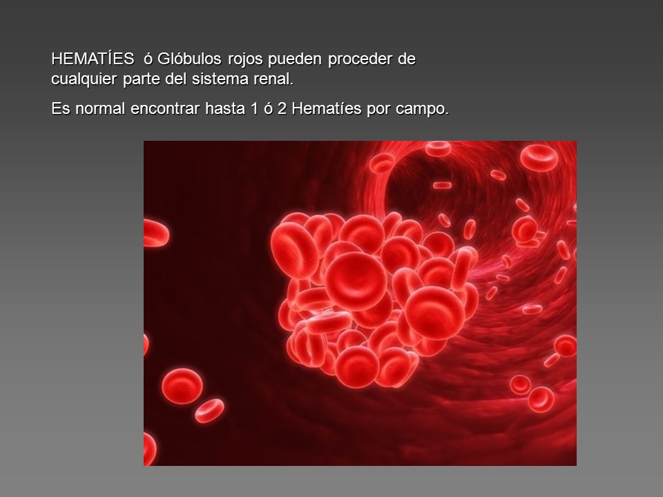HEMATÍES ó Glóbulos rojos pueden proceder de cualquier parte del sistema renal.
