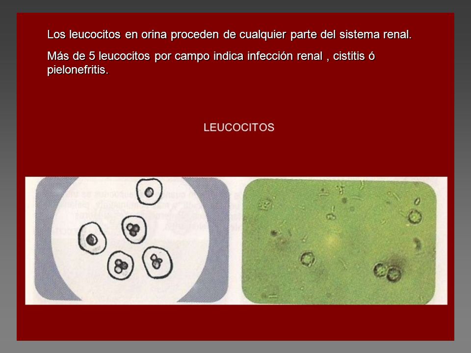 Los leucocitos en orina proceden de cualquier parte del sistema renal.