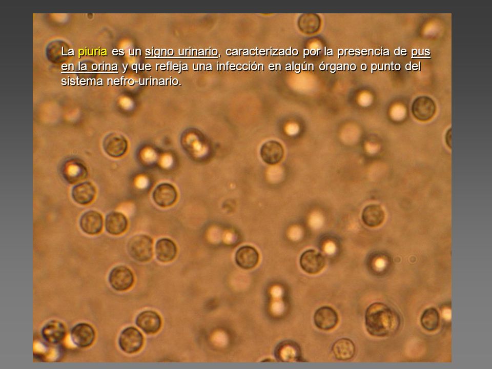La piuria es un signo urinario, caracterizado por la presencia de pus en la orina y que refleja una infección en algún órgano o punto del sistema nefro-urinario.