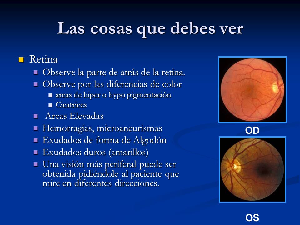 Las cosas que debes ver Retina Observe la parte de atrás de la retina.