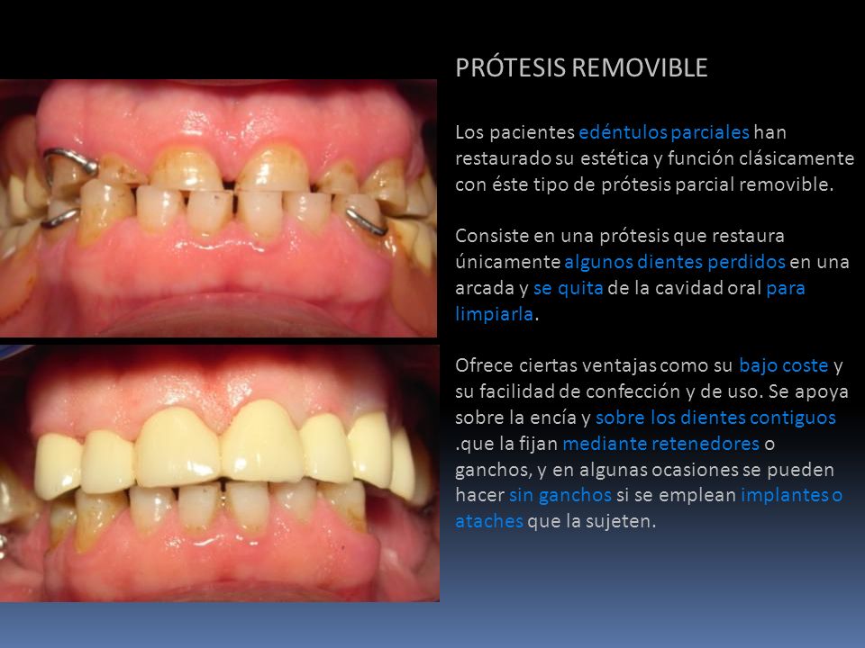 PRÓTESIS REMOVIBLE Los pacientes edéntulos parciales han restaurado su estética y función clásicamente con éste tipo de prótesis parcial removible.