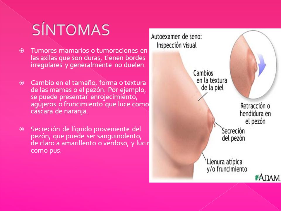 SÍNTOMAS Tumores mamarios o tumoraciones en las axilas que son duras, tienen bordes irregulares y generalmente no duelen.