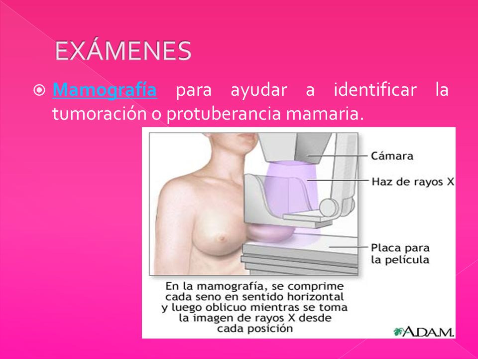 EXÁMENES Mamografía para ayudar a identificar la tumoración o protuberancia mamaria.