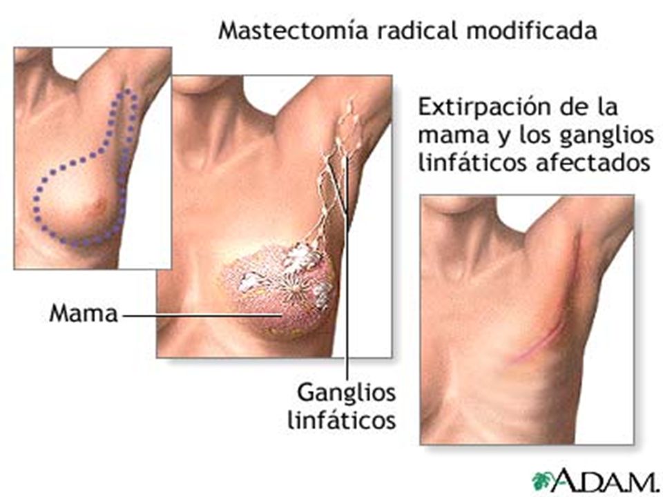 TRATAMIENTO Fármacos quimioterapéuticos para destruir las células cancerosas. Radioterapia para destruir el tejido canceroso.