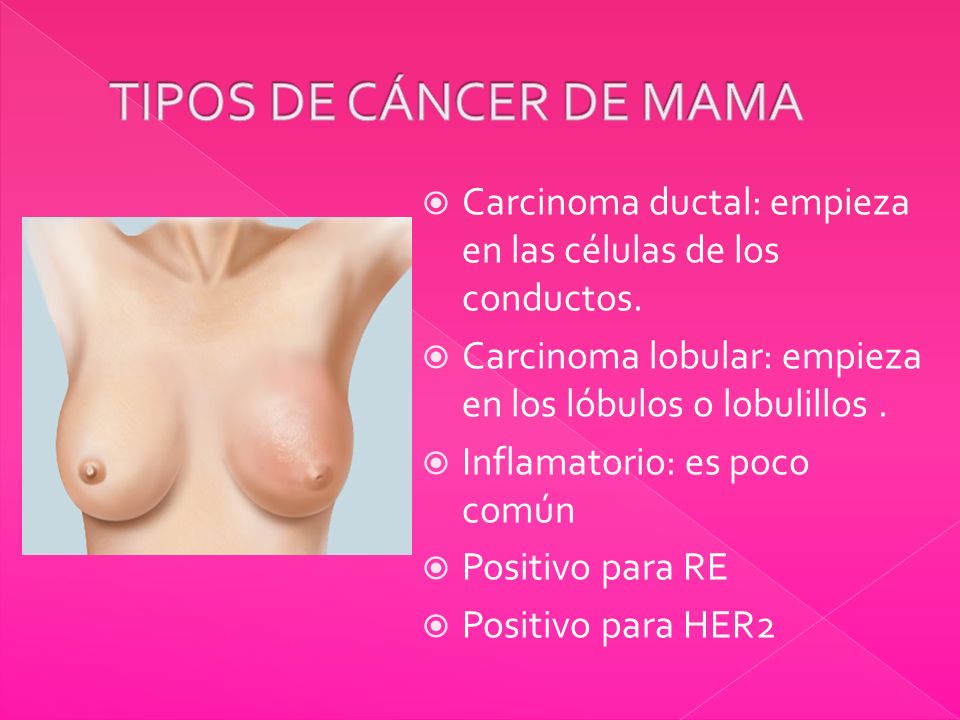 TIPOS DE CÁNCER DE MAMA Carcinoma ductal: empieza en las células de los conductos. Carcinoma lobular: empieza en los lóbulos o lobulillos .