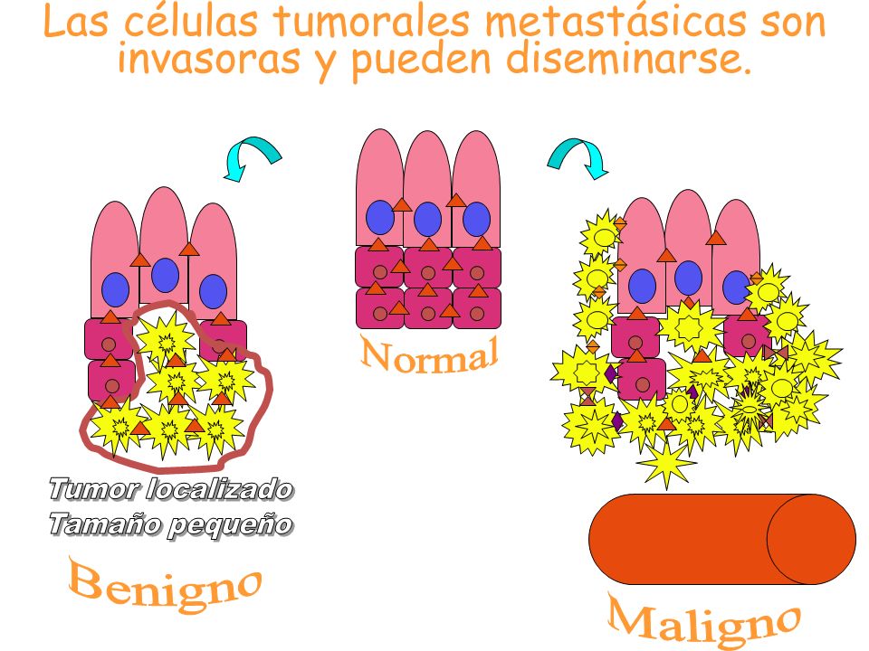 Las células tumorales metastásicas son invasoras y pueden diseminarse.