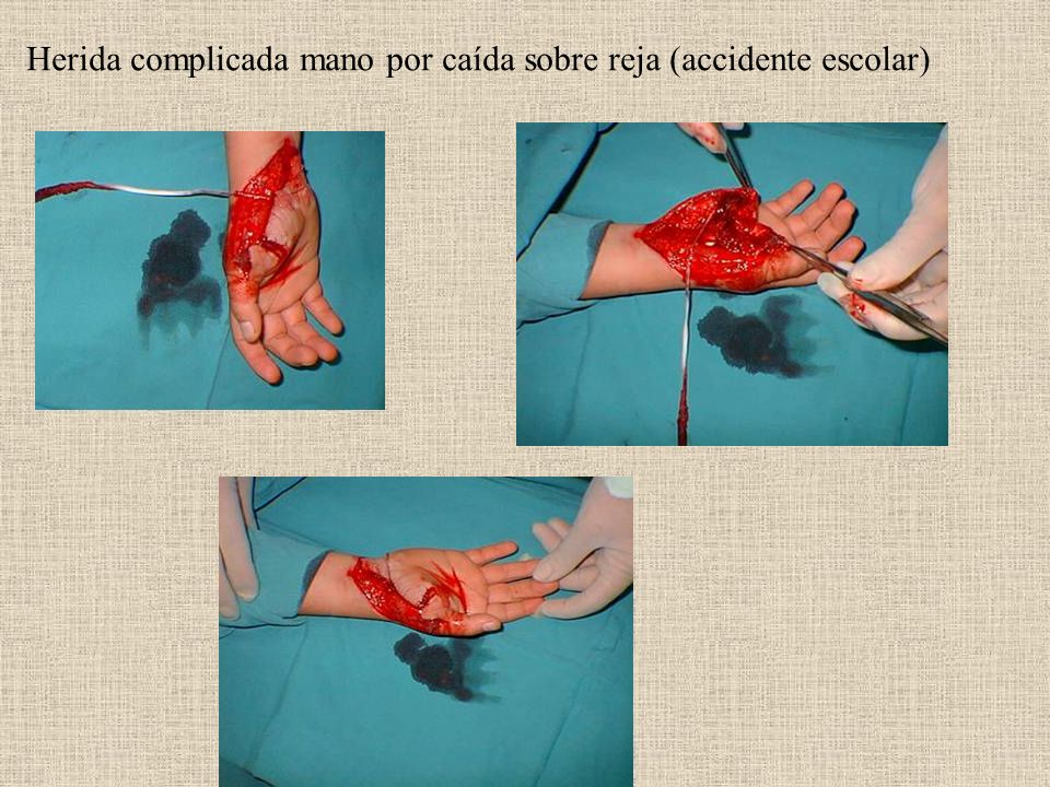 Herida complicada mano por caída sobre reja (accidente escolar)