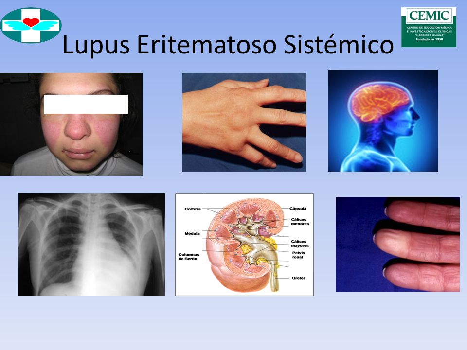 Lupus Eritematoso Sistémico