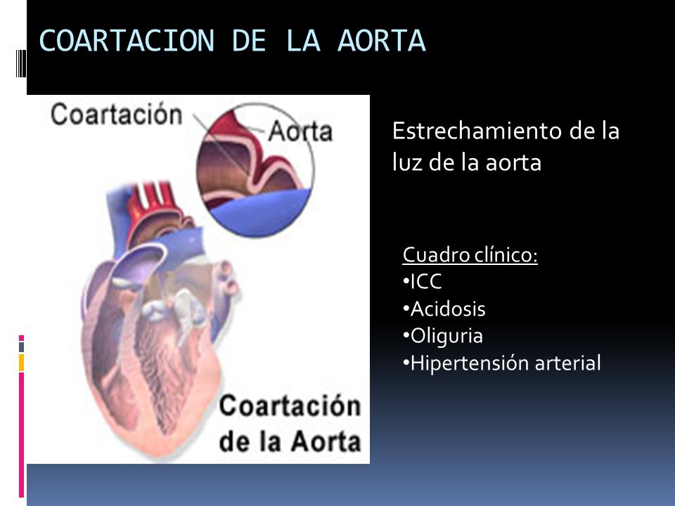 COARTACION DE LA AORTA Estrechamiento de la luz de la aorta