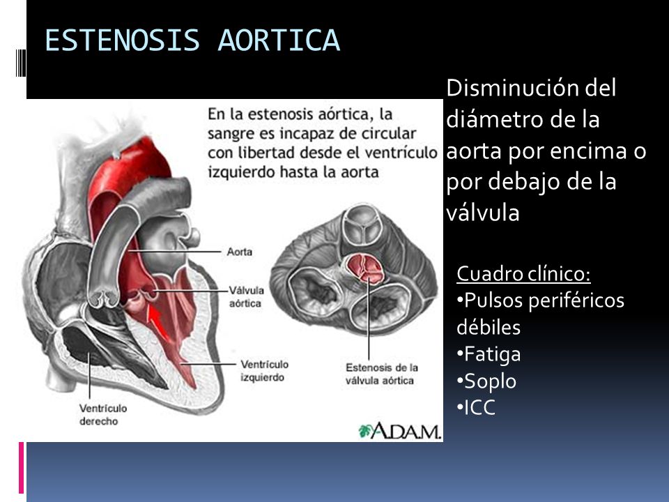 ESTENOSIS AORTICA Disminución del diámetro de la aorta por encima o por debajo de la válvula. Cuadro clínico: