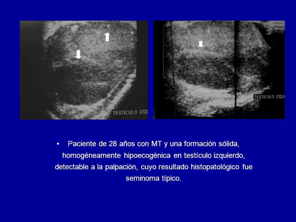 Paciente de 28 años con MT y una formación sólida, homogéneamente hipoecogénica en testículo izquierdo, detectable a la palpación, cuyo resultado histopatológico fue seminoma típico.
