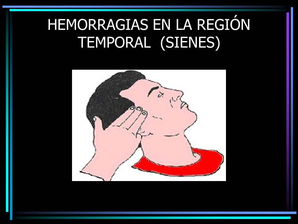 HEMORRAGIAS EN LA REGIÓN TEMPORAL (SIENES)