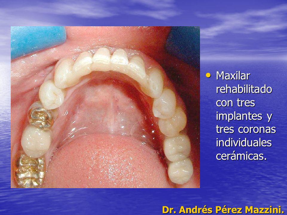 Maxilar rehabilitado con tres implantes y tres coronas individuales cerámicas.
