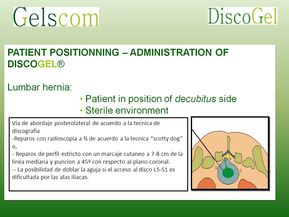 Via de abordaje posterolateral de acuerdo a la tecnica de discografia