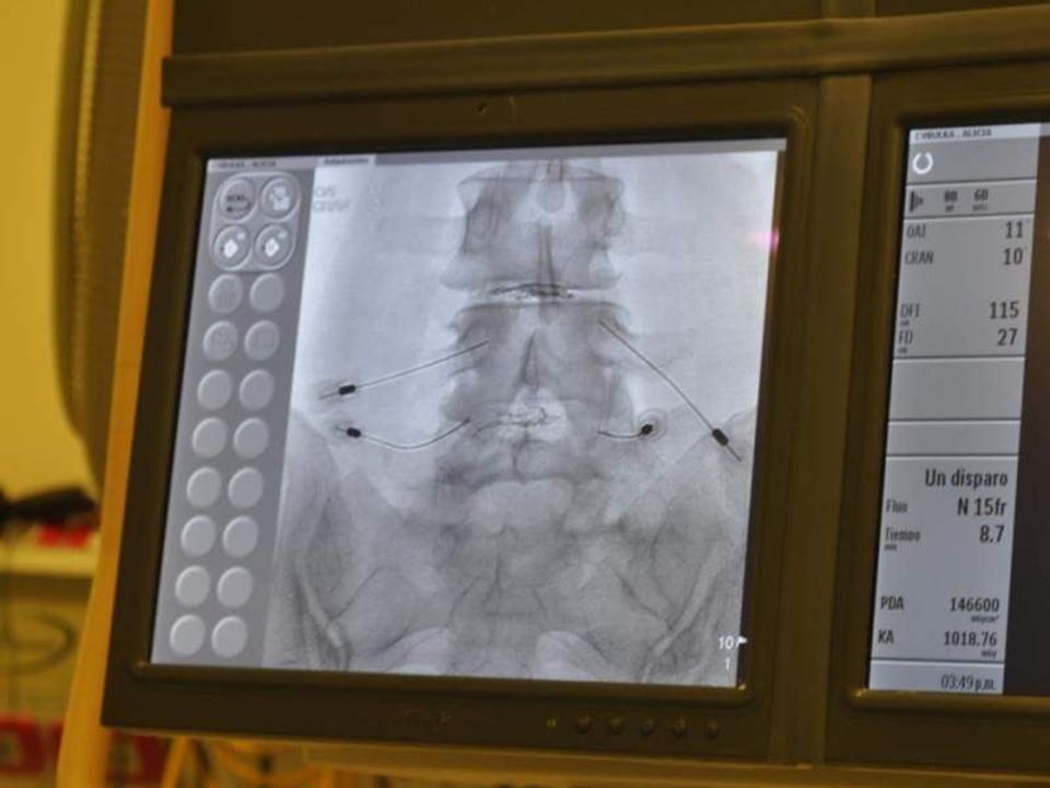 Infiltracion facetaria bilateral a cada nivel en donde se inyecta discogel