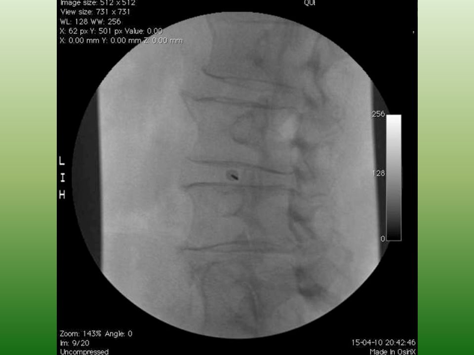 Angula de avanze con la aguja, angiografo en oblicua aprox 35° entre los 2 platillos del cuerpo vertebral bien enfocado, por delante de la orejita del perrito de lachapelle.