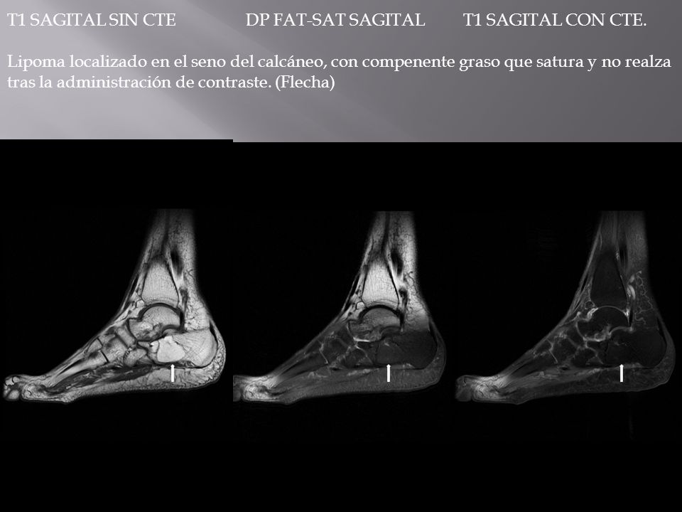 T1 SAGITAL SIN CTE DP FAT-SAT SAGITAL T1 SAGITAL CON CTE.
