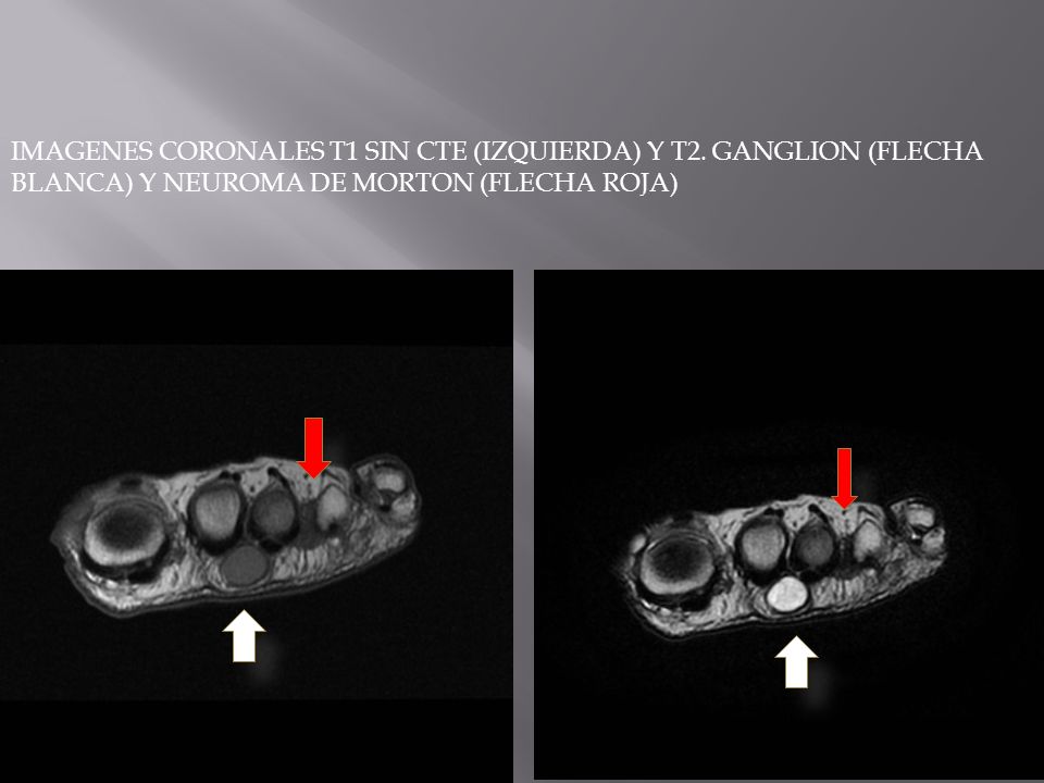 IMAGENES CORONALES T1 SIN CTE (IZQUIERDA) Y T2