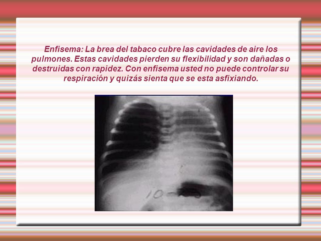 Enfisema: La brea del tabaco cubre las cavidades de aire los pulmones