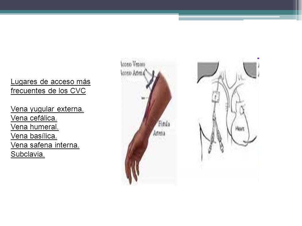 Lugares de acceso más frecuentes de los CVC. Vena yugular externa. Vena cefálica. Vena humeral. Vena basílica.
