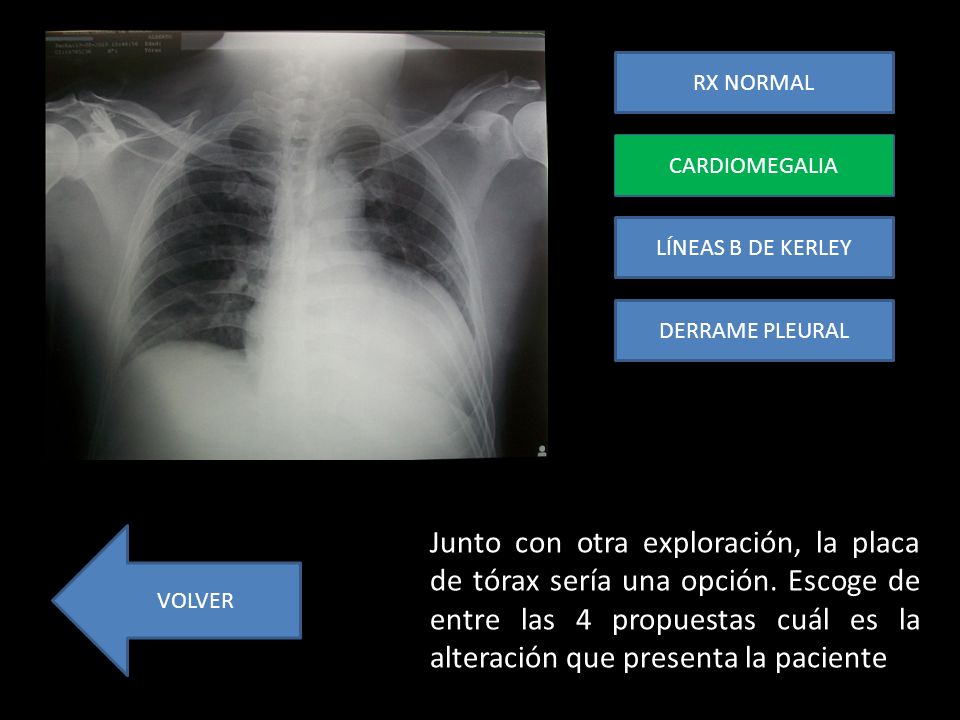 RX NORMAL CARDIOMEGALIA. CARDIOMEGALIA. LÍNEAS B DE KERLEY. DERRAME PLEURAL.
