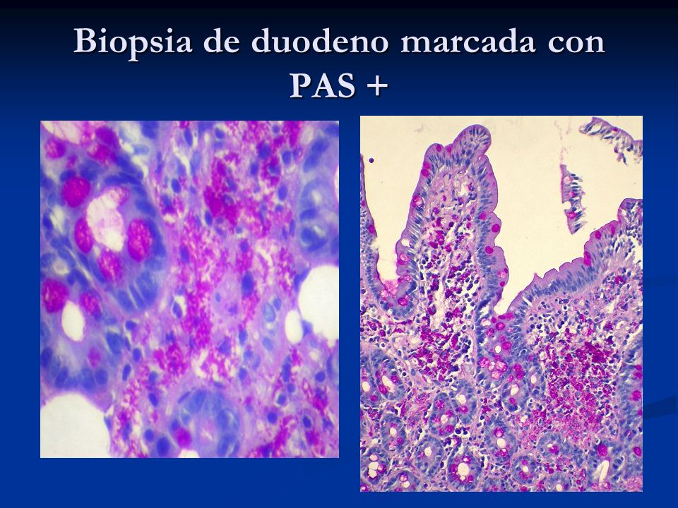 Biopsia de duodeno marcada con PAS +