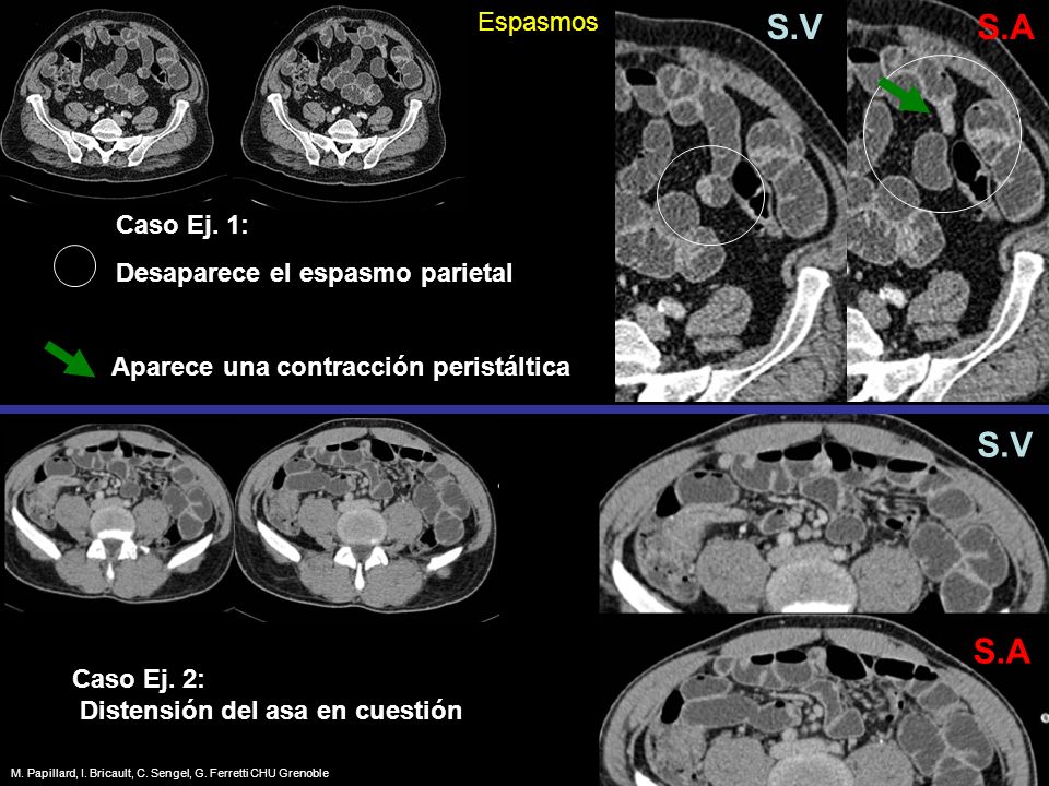 S.V S.A S.V S.A Espasmos Caso Ej. 1: Desaparece el espasmo parietal