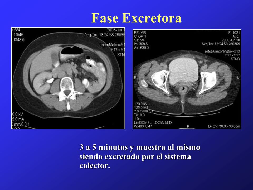 Fase Excretora 3 a 5 minutos y muestra al mismo siendo excretado por el sistema colector.