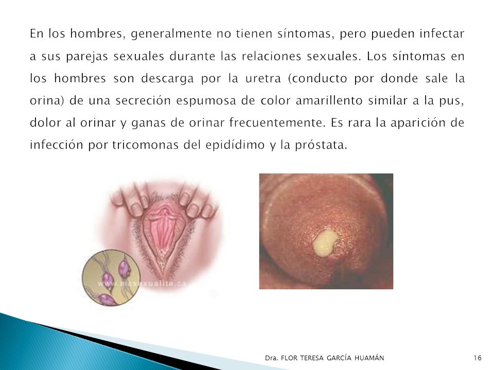 En los hombres, generalmente no tienen síntomas, pero pueden infectar a sus parejas sexuales durante las relaciones sexuales. Los síntomas en los hombres son descarga por la uretra (conducto por donde sale la orina) de una secreción espumosa de color amarillento similar a la pus, dolor al orinar y ganas de orinar frecuentemente. Es rara la aparición de infección por tricomonas del epidídimo y la próstata.