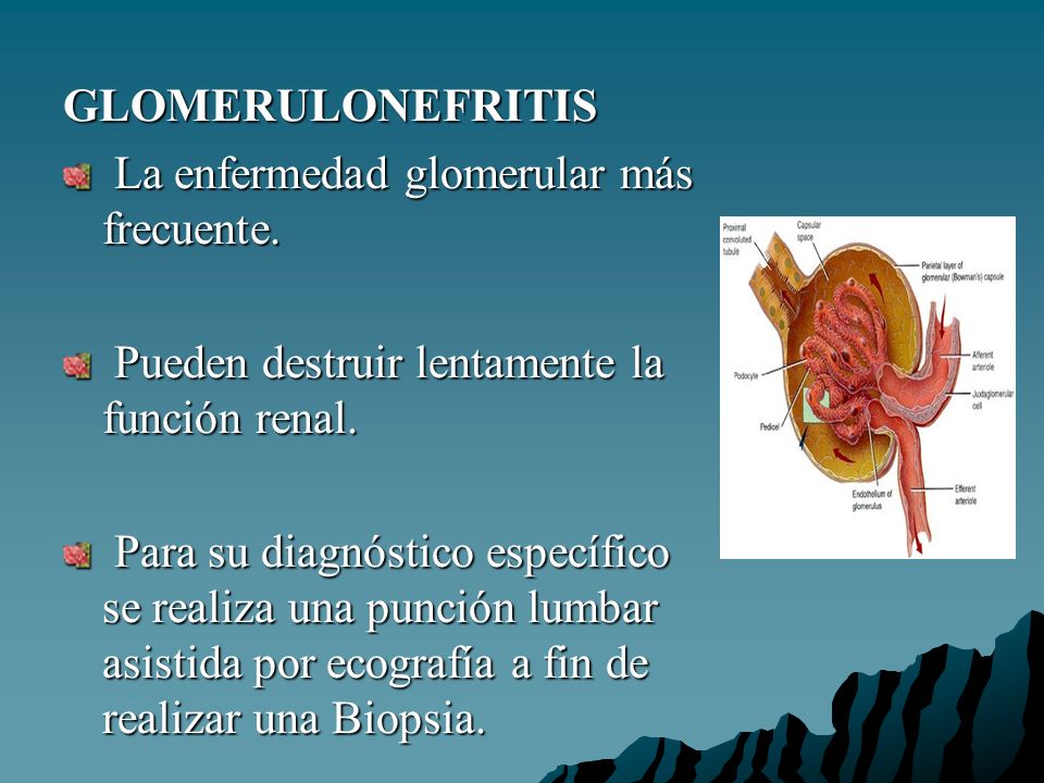 GLOMERULONEFRITIS La enfermedad glomerular más frecuente. Pueden destruir lentamente la función renal.