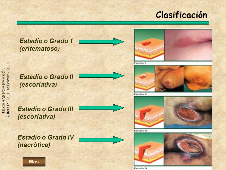 Clasificación Estadío o Grado 1 (eritematoso) Estadío o Grado II