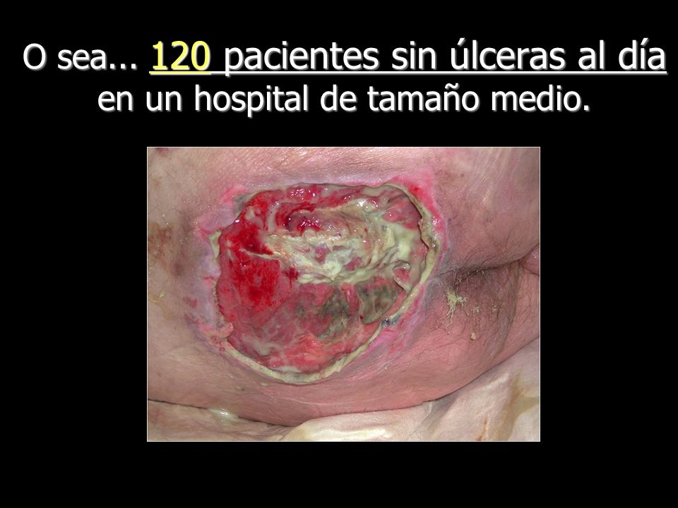 O sea pacientes sin úlceras al día en un hospital de tamaño medio.