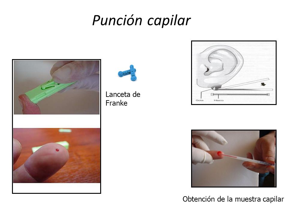 Punción capilar Lanceta de Franke Obtención de la muestra capilar