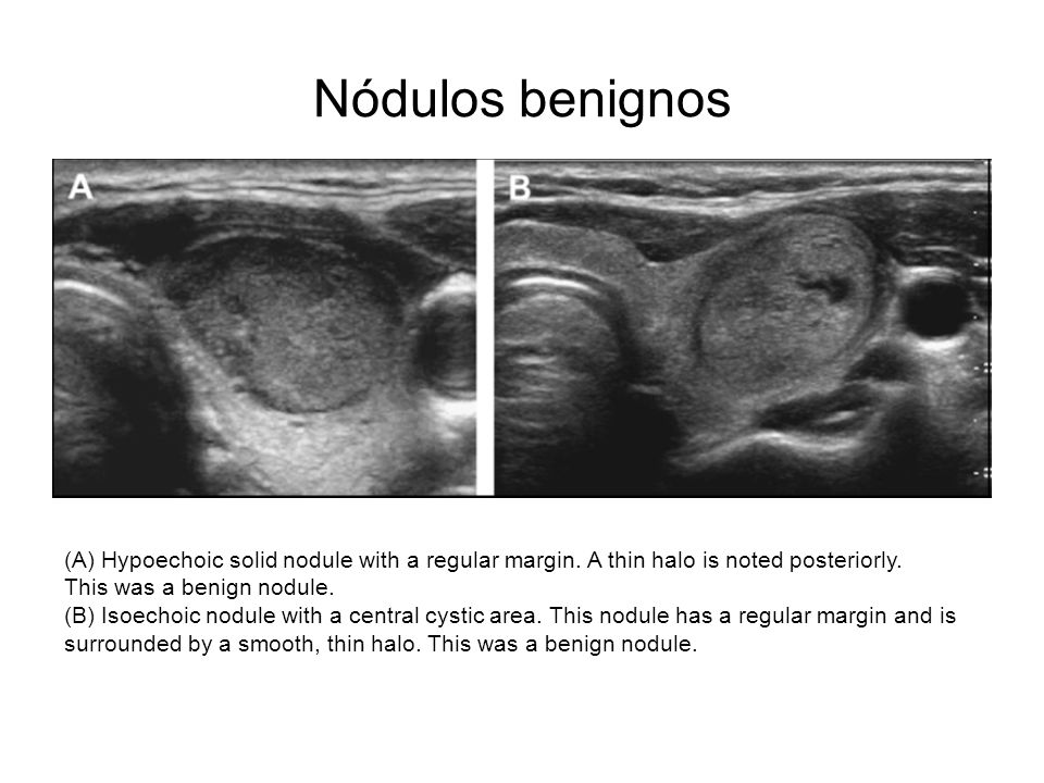 Nódulos benignos (A) Hypoechoic solid nodule with a regular margin. A thin halo is noted posteriorly.