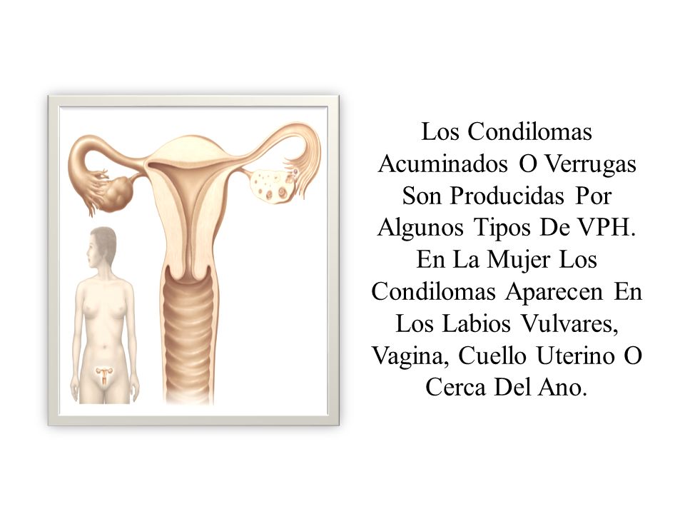 Los Condilomas Acuminados O Verrugas Son Producidas Por Algunos Tipos De VPH.