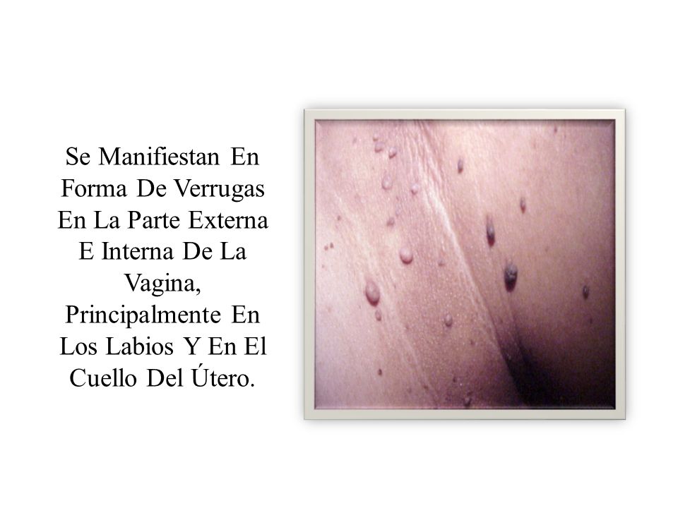 Se Manifiestan En Forma De Verrugas En La Parte Externa E Interna De La Vagina, Principalmente En Los Labios Y En El Cuello Del Útero.