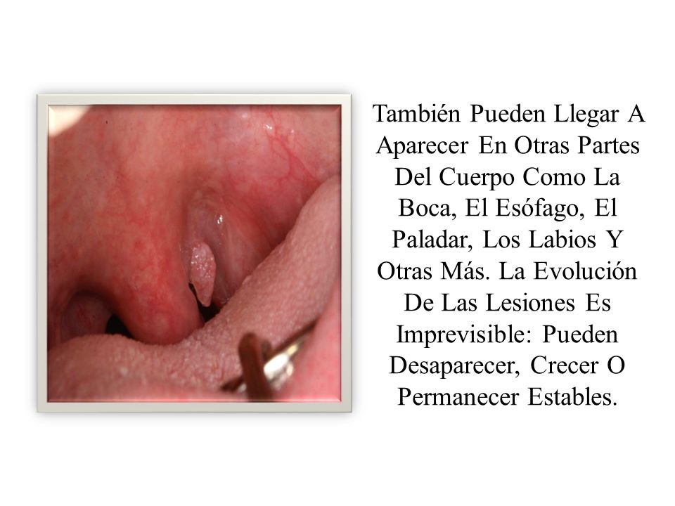 También Pueden Llegar A Aparecer En Otras Partes Del Cuerpo Como La Boca, El Esófago, El Paladar, Los Labios Y Otras Más.