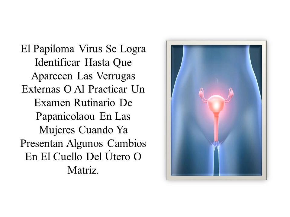 El Papiloma Virus Se Logra Identificar Hasta Que Aparecen Las Verrugas Externas O Al Practicar Un Examen Rutinario De Papanicolaou En Las Mujeres Cuando Ya Presentan Algunos Cambios En El Cuello Del Útero O Matriz.