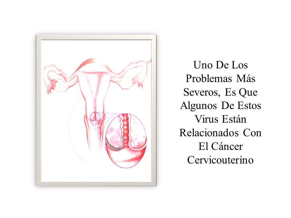 Uno De Los Problemas Más Severos, Es Que Algunos De Estos Virus Están Relacionados Con El Cáncer Cervicouterino