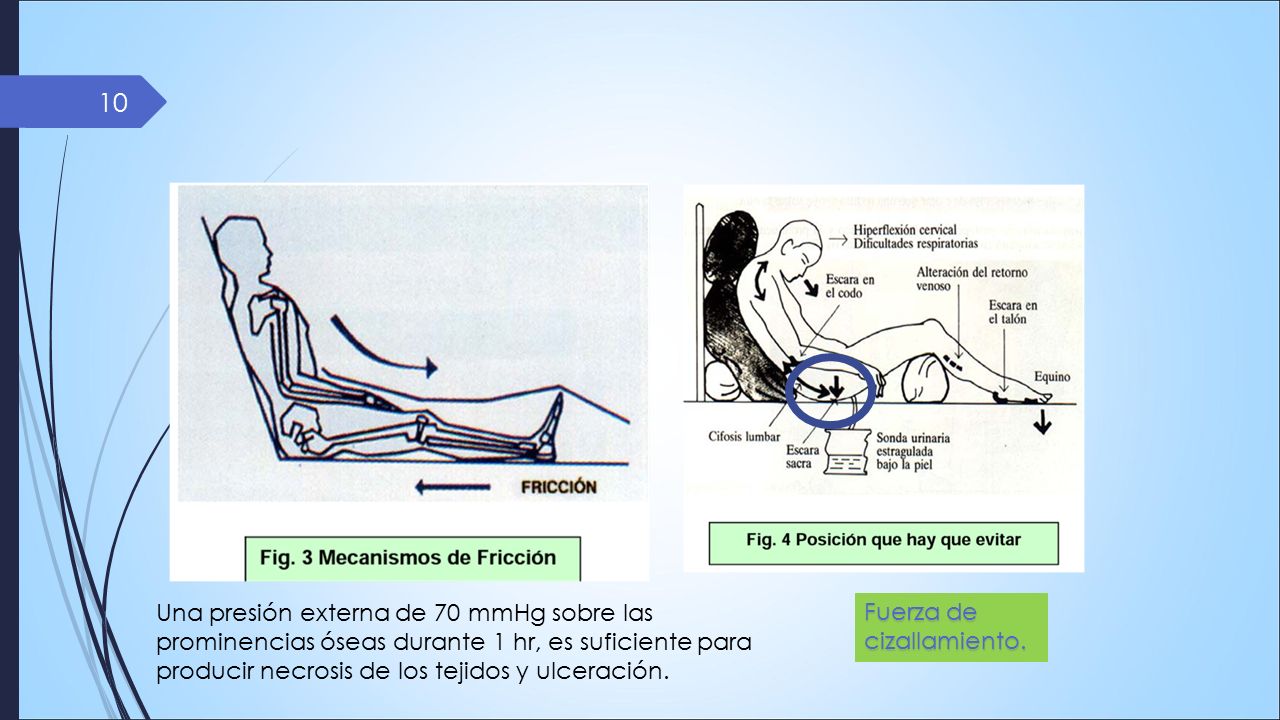 Una presión externa de 70 mmHg sobre las prominencias óseas durante 1 hr, es suficiente para producir necrosis de los tejidos y ulceración.