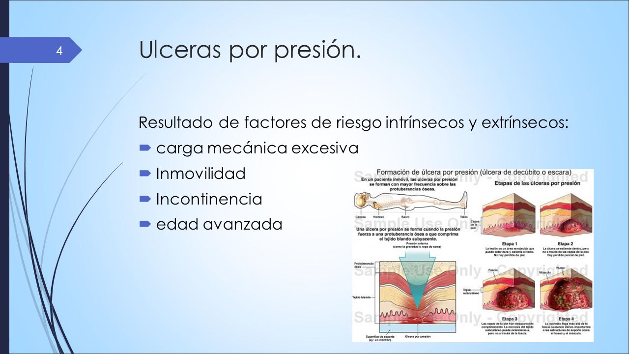 Ulceras por presión. Resultado de factores de riesgo intrínsecos y extrínsecos: carga mecánica excesiva.