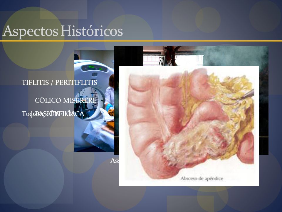 Aspectos Históricos TIFLITIS / PERITIFLITIS CÓLICO MISERERE