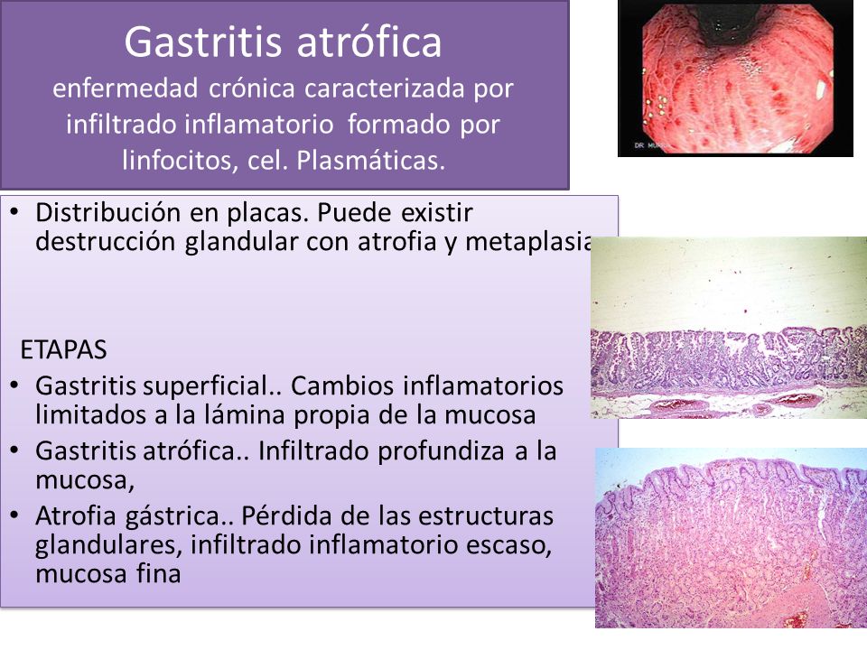 Gastritis atrófica enfermedad crónica caracterizada por infiltrado inflamatorio formado por linfocitos, cel. Plasmáticas.