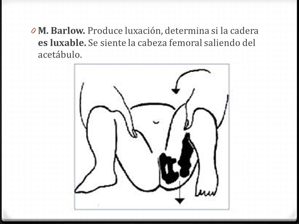 M. Barlow. Produce luxación, determina si la cadera es luxable