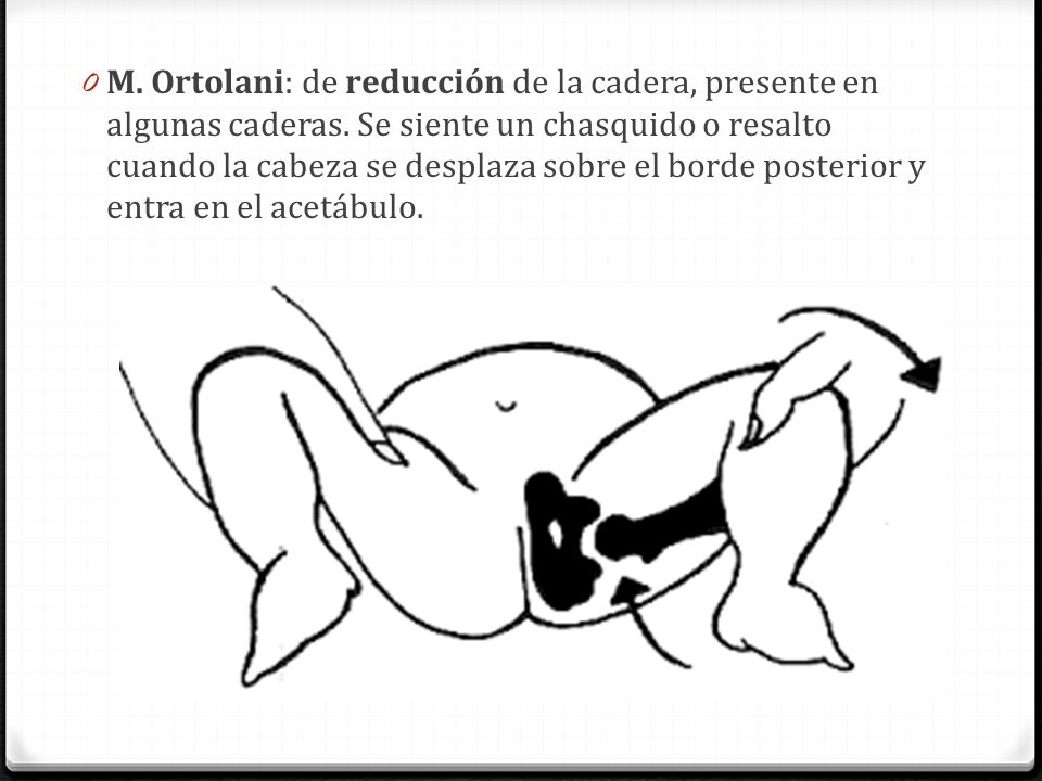 M. Ortolani: de reducción de la cadera, presente en algunas caderas